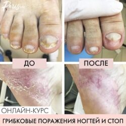 [parisnail] Грибковое поражение ногтей и кожи стоп (Карина Шурыгина)